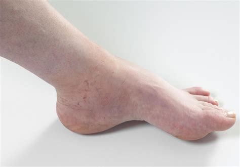What Is An Ankle Edema With Pictures