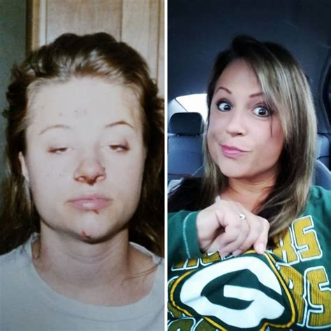 Drug Addict Pictures Before And After