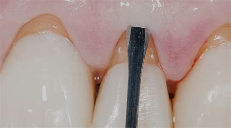 Gingival Recession Treatment With Connective Tissue Graft Rezotto