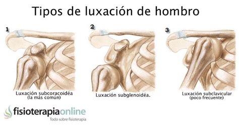 Luxación De Hombro Qué Es Y Cuales Son Sus Tipos Fisioterapia Online