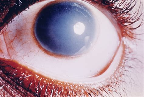 Corneal Dystrophy Congenital Endothelial Hereditary Ocular Diseases