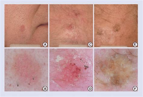Non Surgical Management Of Actinic Keratoses And Non Melanoma Skin My