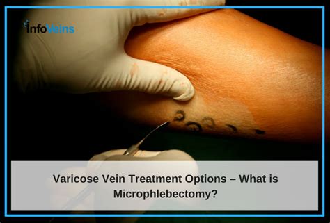 What Is Microphlebectomy Varicose Vein Treatment Options