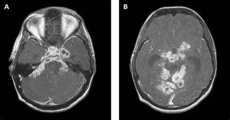 Acute Hydrocephalus In The Neurointensive Care Unit Etiology