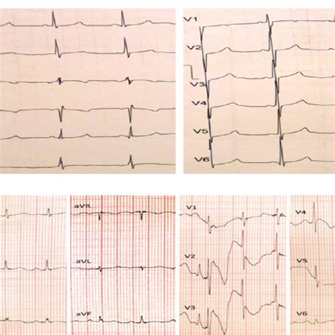 Ecg Of The Patients A The 12 Lead Electrocardiogram Of The Patient A