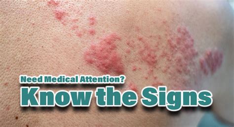 Signs Your Rash Needs Medical Attention Mega Doctor News