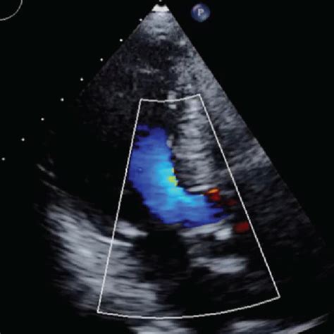 The Preoperative Echocardiogram Was Showing No Obstruction Of The Left