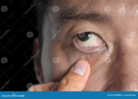 Pale Skin Of Asian Man Sign Of Anemia Stock Image Image Of Isolated