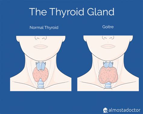 Hypothyroidism Almostadoctor