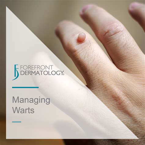 Managing Warts Forefront Dermatology