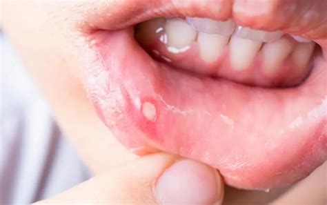 Types Of Ulcers What They Look Like Symptoms Causes Treatments Health
