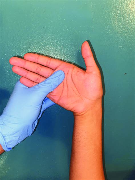 Passive Ulnar Wrist Deviation If Pain Is Elicited This Is A Positive