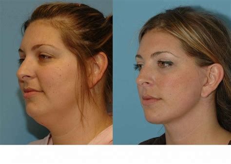 4 Face Yoga Exercises To Make Your Face Like After Doing Facelift