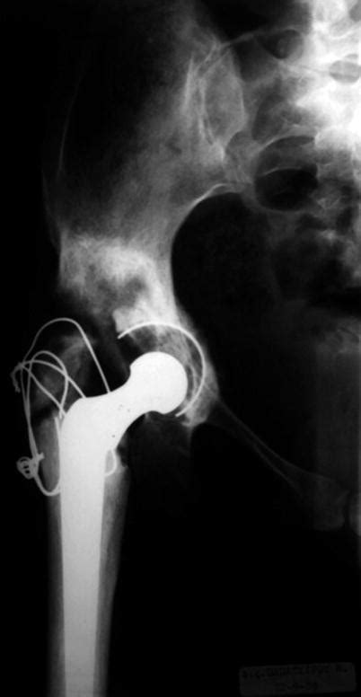 Hip Replacement Surgery The Recovery Process Brandon Orthopedics