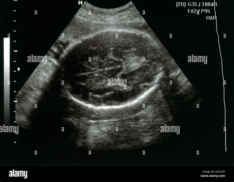 Fetalen Ultraschall Zeigt Den Kopf Des Fötus Stockfoto Bild 14167598