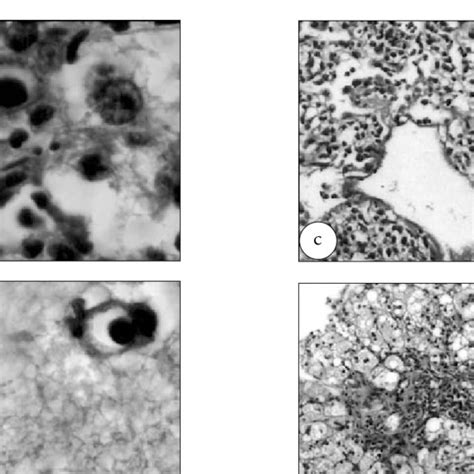 Congenital Cytomegalovirus Infection A And B Bile Duct And Neuron With