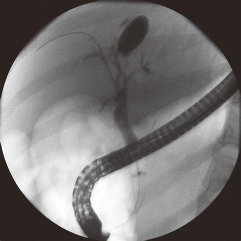 Diagnostic And Therapeutic Direct Peroral Cholangioscopy Using An