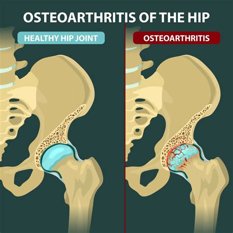 Osteoarthritis Of The Hip Florida Orthopaedic Institute