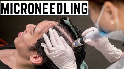 Microneedling For Hair Loss Before And After Chicago Youtube