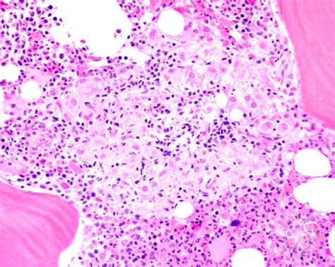 Bone loss in edentulous jaws negatively influences the functions of the stomatognathic system. Bone marrow granuloma - 2.