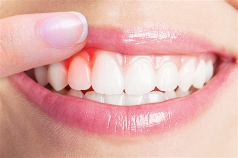 Gum Disease Treatment In Vaughan Maple Dental Hygiene Care