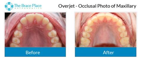 Occlusal Photo Of Maxillary The Brace Place Orthodontics