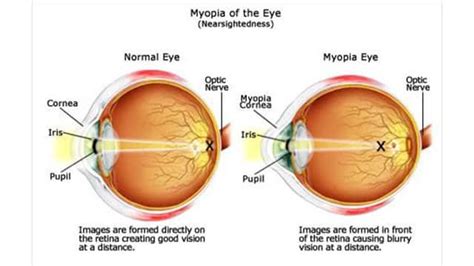Myopia (nearsighted) - Everyday Sight
