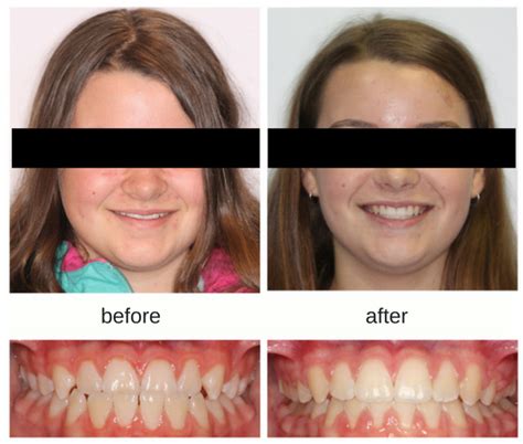 Teen Invisalign And Braces Before And After Hometown Orthodontics