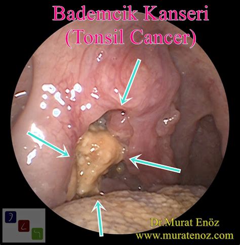 Tonsil Cancer Causes Symptoms Diagnosis And Treatment