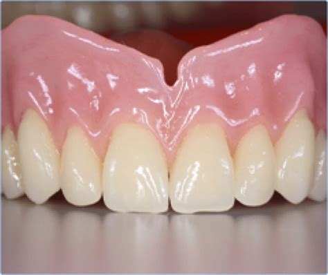 Immediate Dentures Free Estimate Richmond Denture Clinic