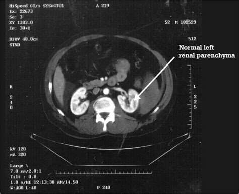 Ct Scan The Left Kidney Noted No Extravasation Or Parenchymal Injury