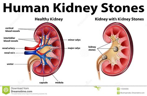 Kidney Stones Icon Inflammation In Human Body Medical Anatomical