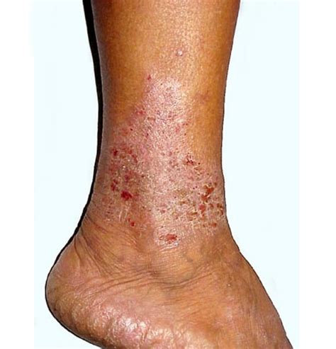Vein Stasis Dermatitis Overview Causes Symptoms Treat