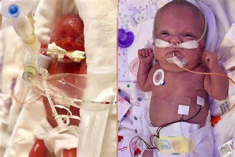 Photos Show Incredible Transformation Of Premature Baby Born At 23