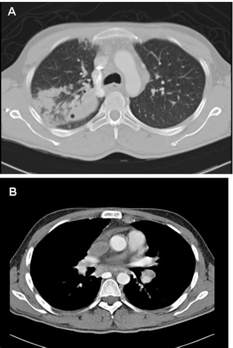 Chest Ct Scan Showed Right Lung Consolidation A With Enlarged