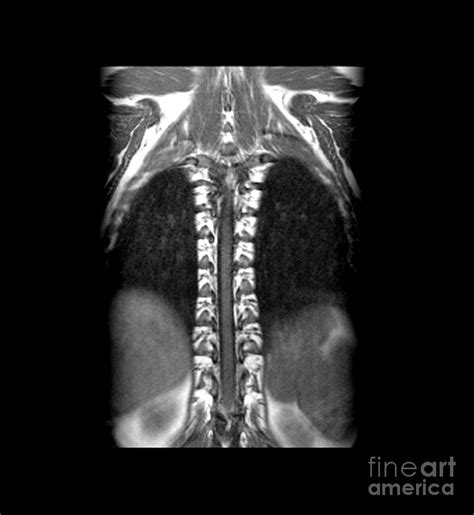 Normal Mri Of Thoracic Spinal Cord Photograph By Medical Body Scans