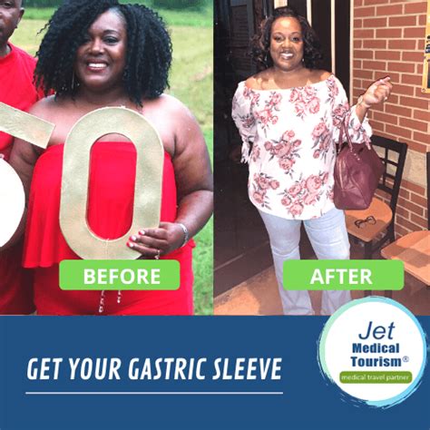 Gastric Sleeve Before And After Pictures Best Photos 2022 2022