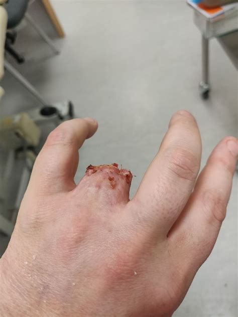 Https://favs.pics/wedding/finger Ripped Off By Wedding Ring
