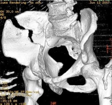 Fratture di acetabolo