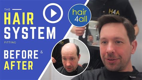 Before And After Hair System Non Surgical Hair Replacement System For Menwomen Ukusaintl