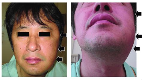 Swelling On The Left Side Of The Patients Face The Swelling On The