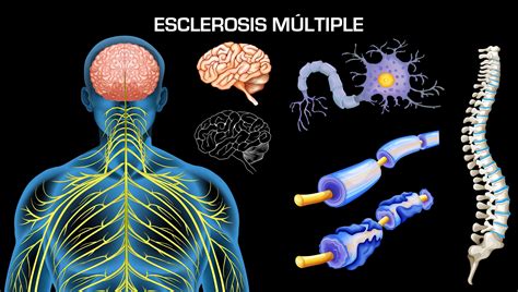 La esclerosis múltiple es una enfermedad que padecen mayormente los adultos y que se suele diagnosticar en pacientes de entre 20 y 50 años de edad. 30 de mayo. Día Mundial de la Esclerosis Múltiple ...