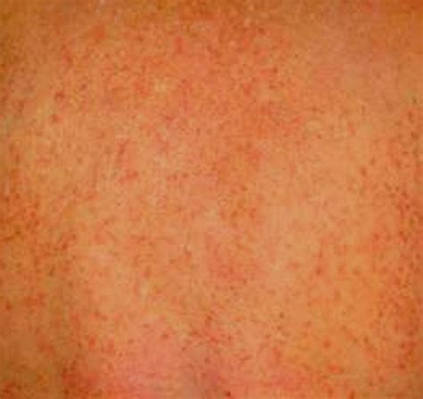 Chlorine Rash Pictures Causes And Treatments