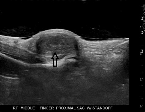 Giant Cell Tumor Of The Tendon Sheath In A Male Pediatric Patient