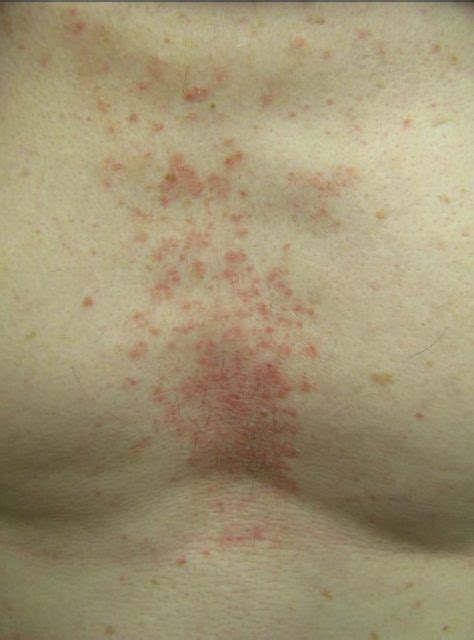 Clinical Challenge Patchy Rash On Chest Mpr