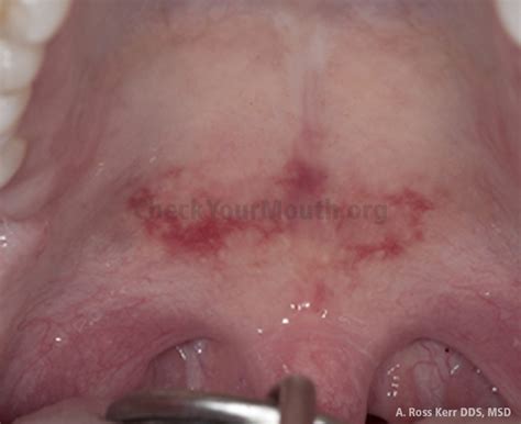 Pictures Of Sores On The Roof Of Your Mouth Picturemeta