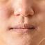 How To Treat Nose Eczema  Itchylittleworldcom