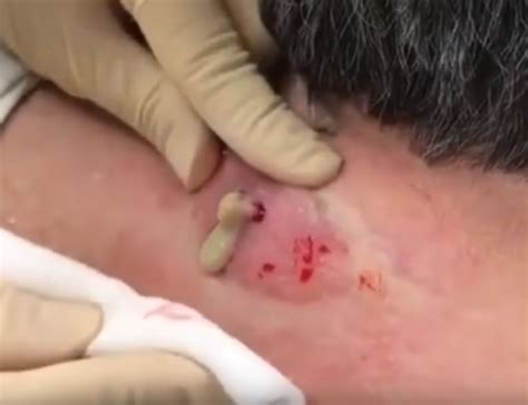 Dr Pimple Popper Inflamed Back Cyst Dr Pimple Popper Cyst On Back New