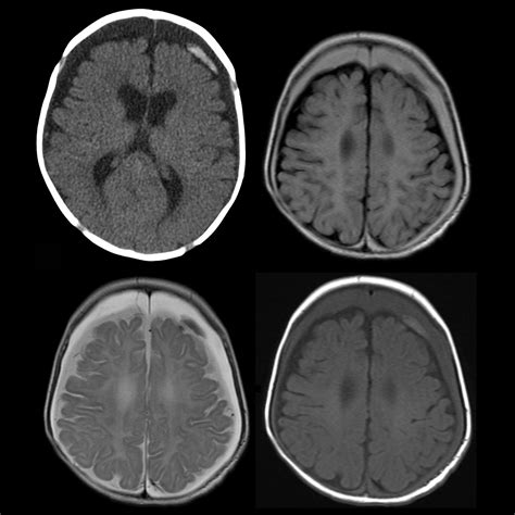 Pediatric Subdural Hematoma Pediatric Radiology Reference Article The Best Porn Website
