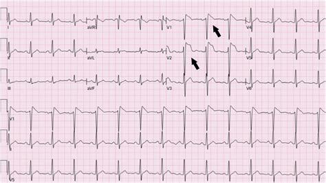 Cureus St Elevation In A Patient With Covid 19 Infection Associated